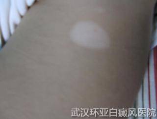 专家警告:慎用白癜风偏方