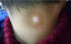 白癜风患者食疗有什么禁忌