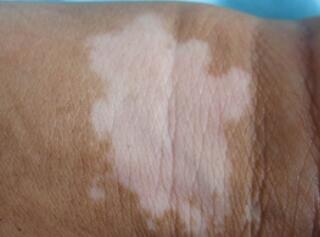 武汉白癜风自我诊断怎么进行 武汉白癜风自我诊断怎么进行