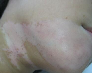 武汉白癜风怎么识别最准确 武汉白癜风怎么识别最准确