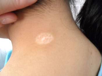 武汉小儿白癜风临床症状 武汉小孩白癜风初期症状有哪些