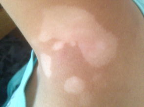 武汉少年白癜风症状特点有哪些 武汉少年白癜风症状特点有哪些