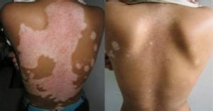 夏季白癜风的症状表现有哪些 泛发型白癜风是什么样呢