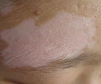 年轻人白癜风治疗如何护理比较好 怎么可以更加准确的治疗白癜风