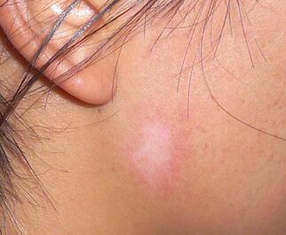 少年白癜风该如何去治疗才好 防止白癜风扩散该采取哪些措施